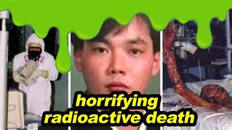 Hisashi Ouchi, The Radioactive Man Kept Alive For 83 Days